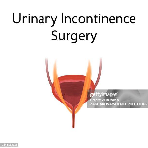 Stress Incontinence Animation 11 Stress Urinary Incontinence High Res Illustrations - Getty Images