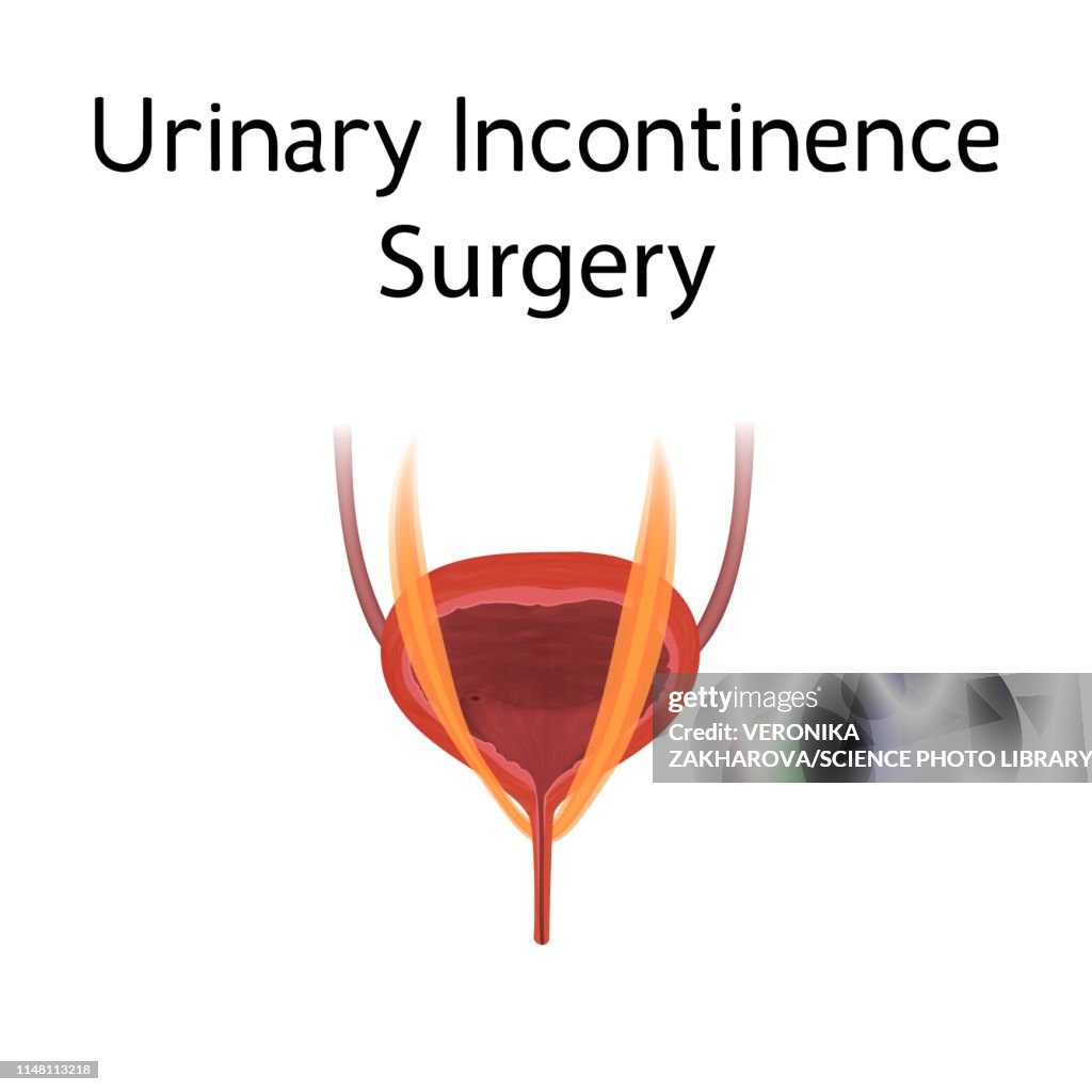 Urinary Incontinence Drawing Urinary Incontinence Surgery Illustration High-Res Vector Graphic ...