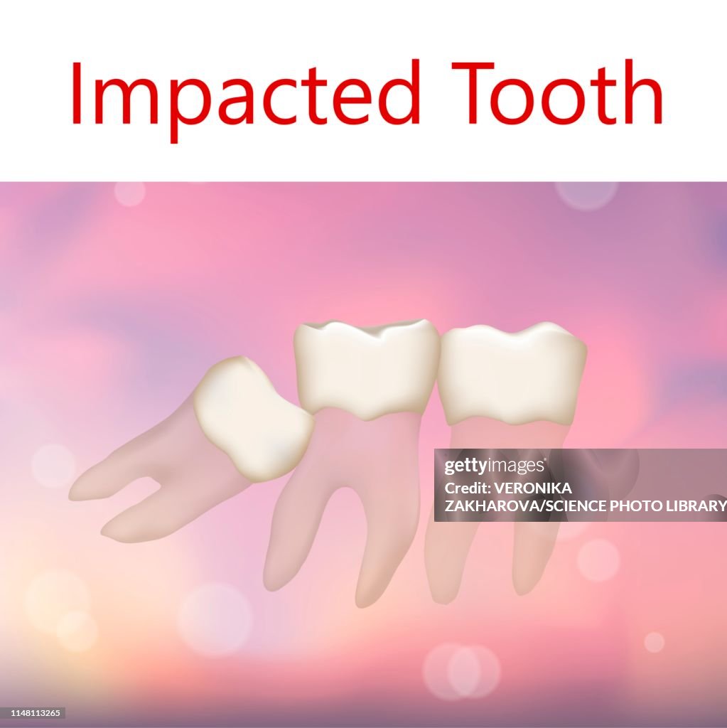 Simple Tooth Impaction Impacted Tooth Illustration High-Res Vector Graphic - Getty Images