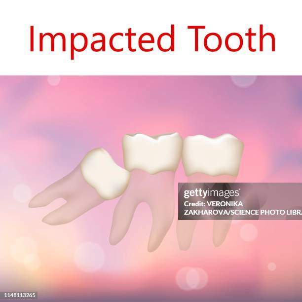 33 Impacted Teeth Stock Photos, High-Res Pictures, and Images - Getty ...