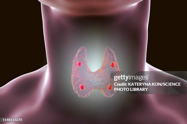 parathyroid glands, illustration - nebenschilddrüse stock-grafiken, -clipart, -cartoons und -symbole