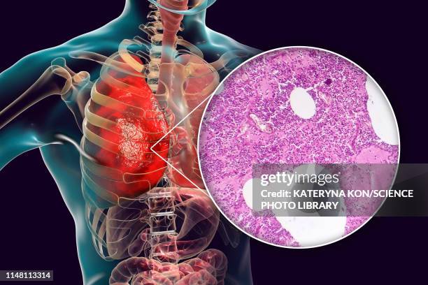 lobar pneumonia, illustration and light micrograph - light micrograph stock illustrations