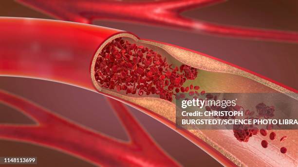 illustrations, cliparts, dessins animés et icônes de arteriosclerosis, illustration - artère humaine