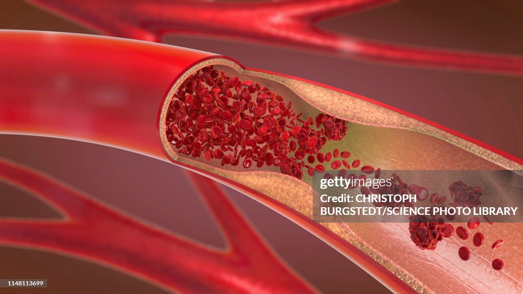 Arteriosclerosis, illustration