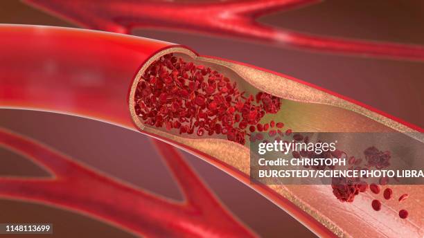 arteriosclerosis, illustration - blood clot stock illustrations