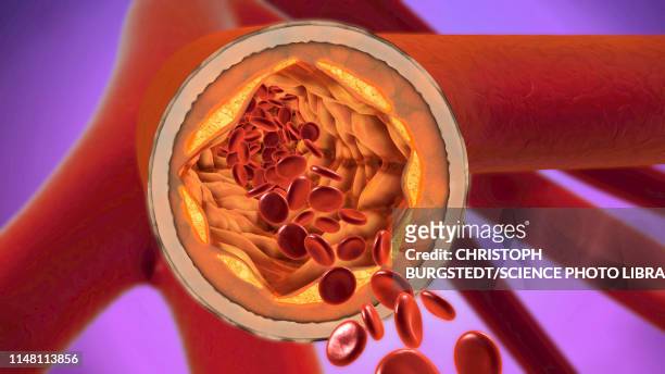 ilustraciones, imágenes clip art, dibujos animados e iconos de stock de atherosclerosis, illustration - coágulo de sangre