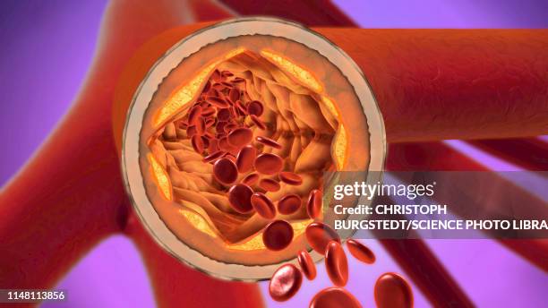 bildbanksillustrationer, clip art samt tecknat material och ikoner med atherosclerosis, illustration - plaque