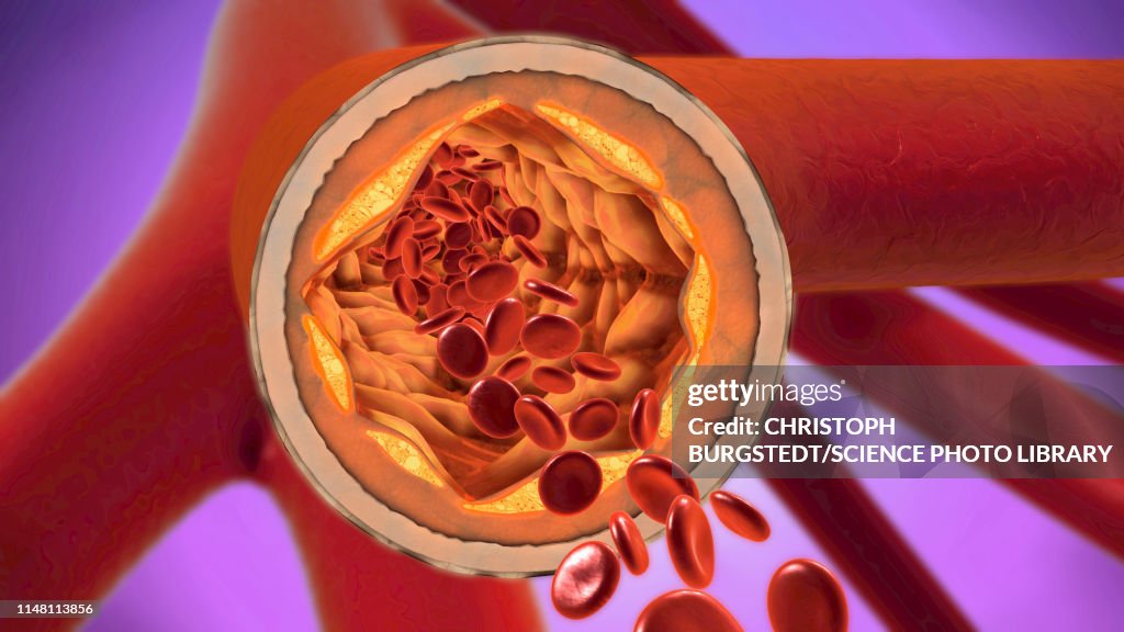 Atherosclerosis, illustration