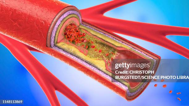 illustrations, cliparts, dessins animés et icônes de atherosclerosis, illustration - caillot sanguin