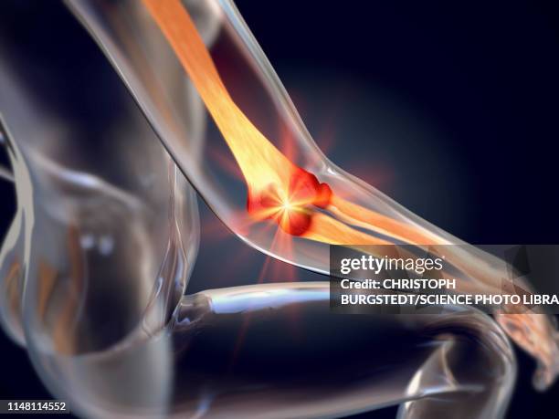 tennis elbow, illustration - elbow stock illustrations