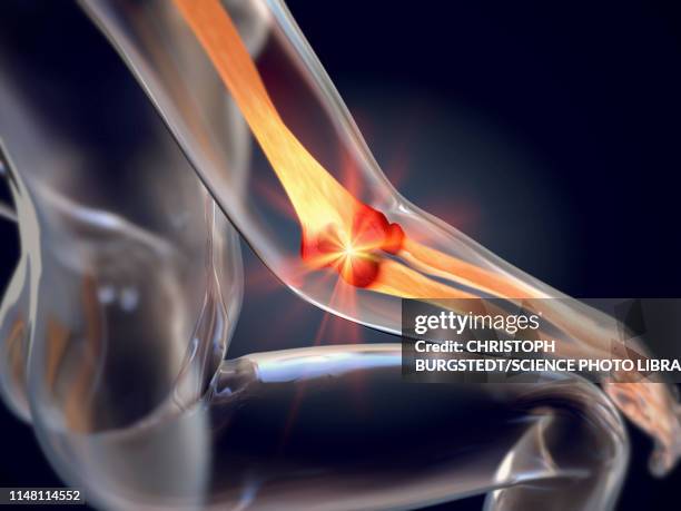 tennis elbow, illustration - rheumatism stock illustrations