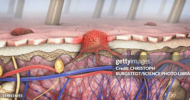 melanoma, illustration - human skin cross section stock pictures, royalty-free photos & images