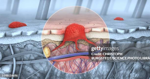 melanoma, illustration - carcinoma stock pictures, royalty-free photos & images