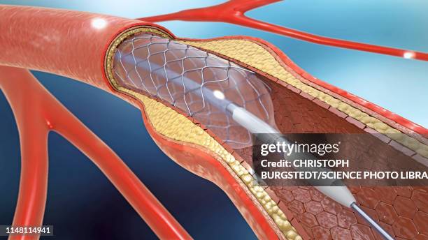 arterial stent, illustration - cateter imagens e fotografias de stock