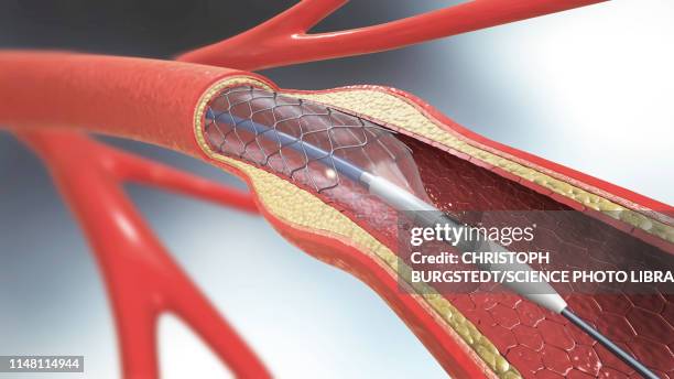 arterial stent, illustration - angioplasty stock pictures, royalty-free photos & images