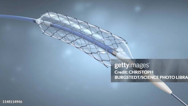 balloon stent, illustration - balloon catheter stock pictures, royalty-free photos & images