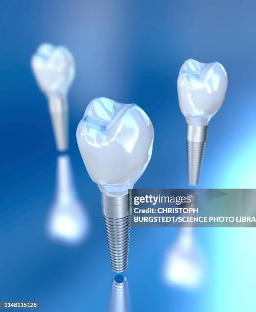 dental implants, illustration - human teeth stock illustrations