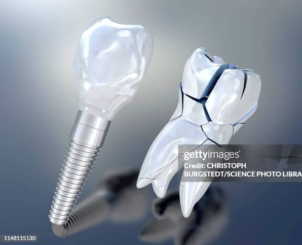 dental implant, illustration - rotten teeth from not brushing 幅插畫檔、美工圖案、卡通及圖標