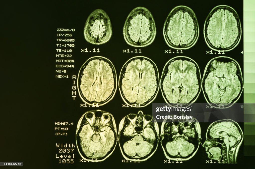 MRI scan or magnetic resonance image of head and brain scan. The result is an MRI of the brain with values and numbers with yellow backlight.