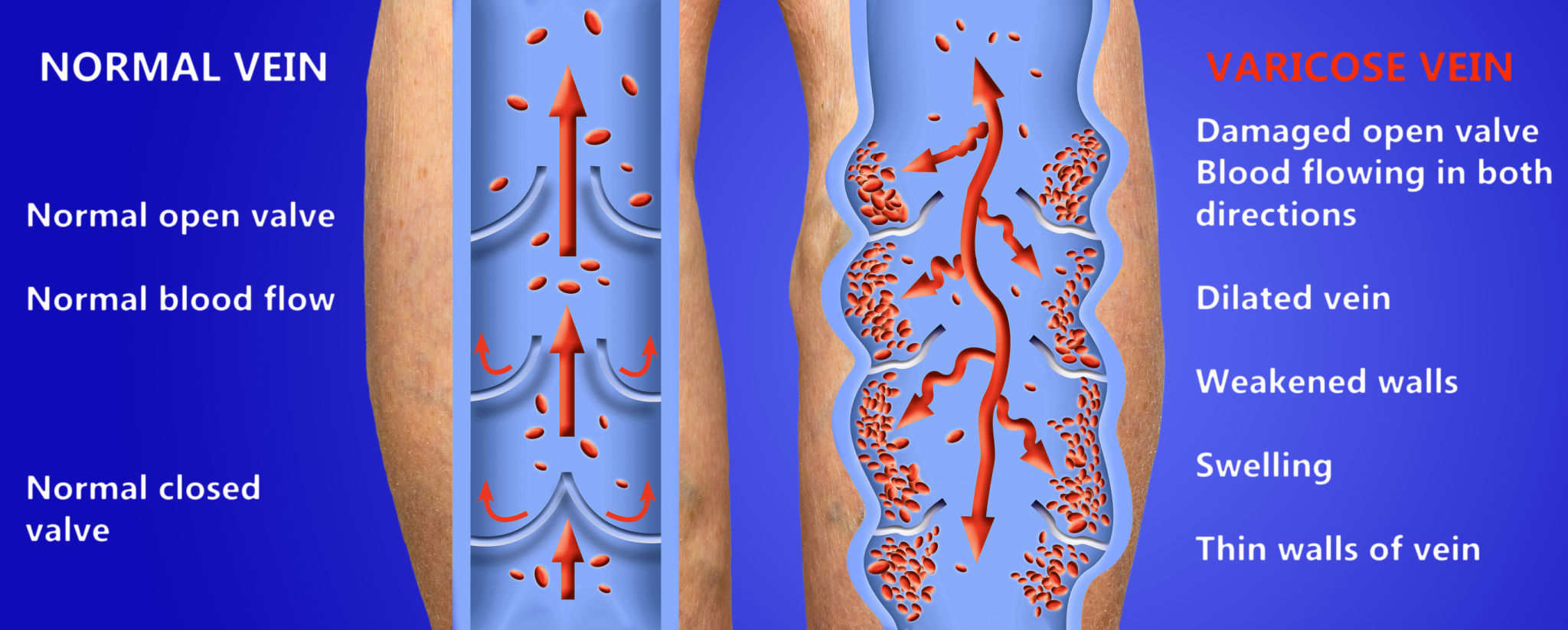 Varicose veins on a female senior legs. The structure of normal and varicose veins. Varicose veins on a female senior legs. The structure of normal and varicose veins.