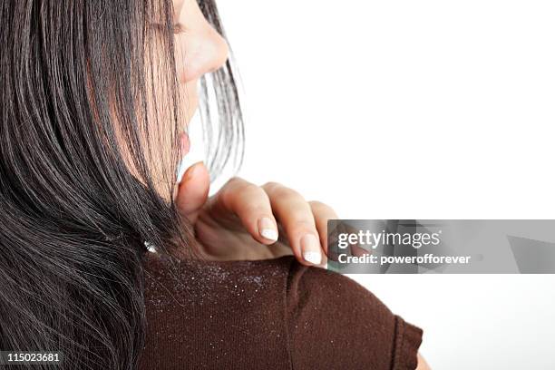 dandruff - dandruff stock pictures, royalty-free photos & images