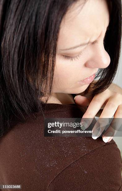 dandruff - dandruff stock pictures, royalty-free photos & images