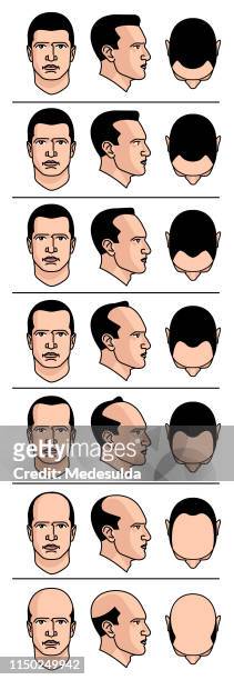 ilustraciones, imágenes clip art, dibujos animados e iconos de stock de diagrama de calvicie - human scalp