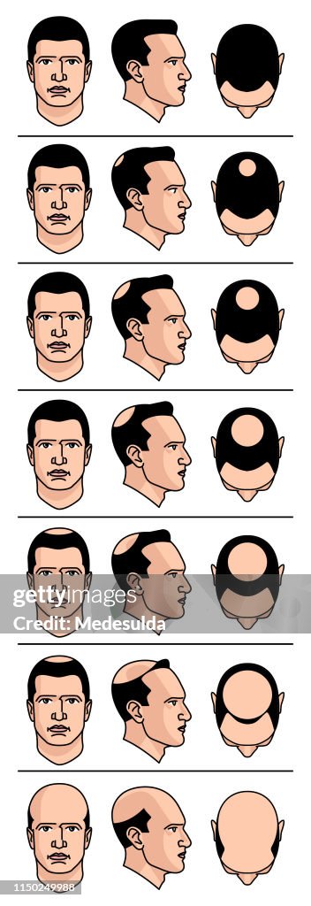 Hair Loss Diagram High-Res Vector Graphic - Getty Images Hair Loss Diagram High-Res Vector Graphic - Getty Images