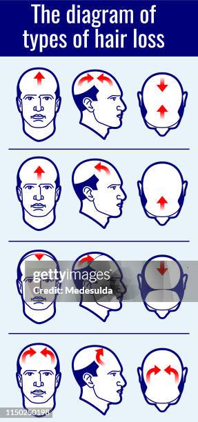 hair loss types - male hair removal stock illustrations