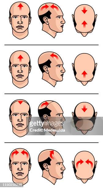 Hair Loss Diagram High-Res Vector Graphic - Getty Images