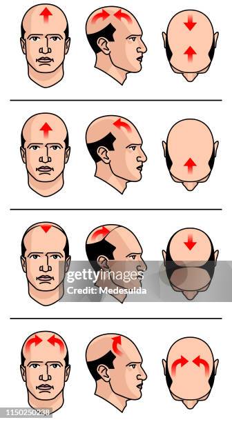 Hair Loss Diagram High-Res Vector Graphic - Getty Images Hair Loss Diagram High-Res Vector Graphic - Getty Images