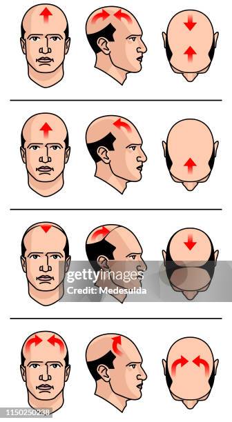 hair loss types - male hair removal stock illustrations