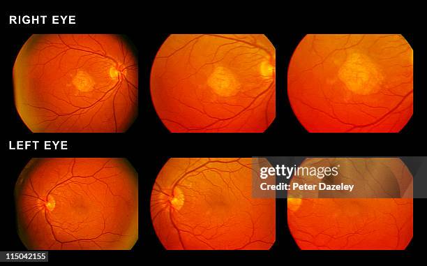 scan of eyes showing macular degeneration - nerf optique photos et images de collection