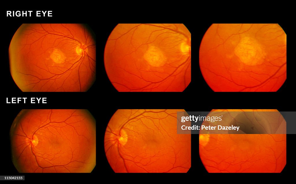 Scan of eyes showing macular degeneration