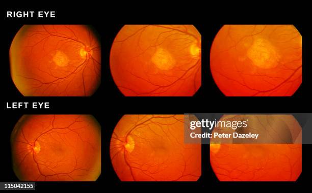 scan of eyes showing macular degeneration - retina stock pictures, royalty-free photos & images