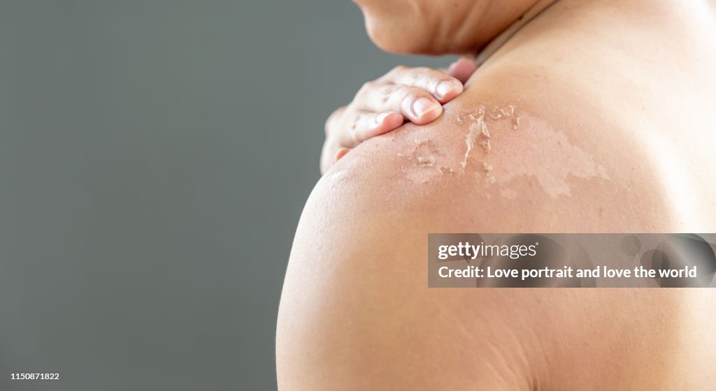 Skin care concept. Asian guy got sunburn and got tan lines on his shoulder and back. The skin sloughs off its on his shoulder. It is the cause of melanoma. He has burning pain on shoulder. copy space