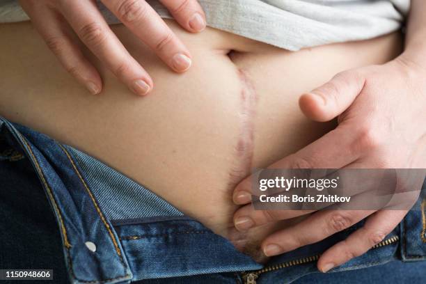 scar on woman belly - histerectomia fotografías e imágenes de stock