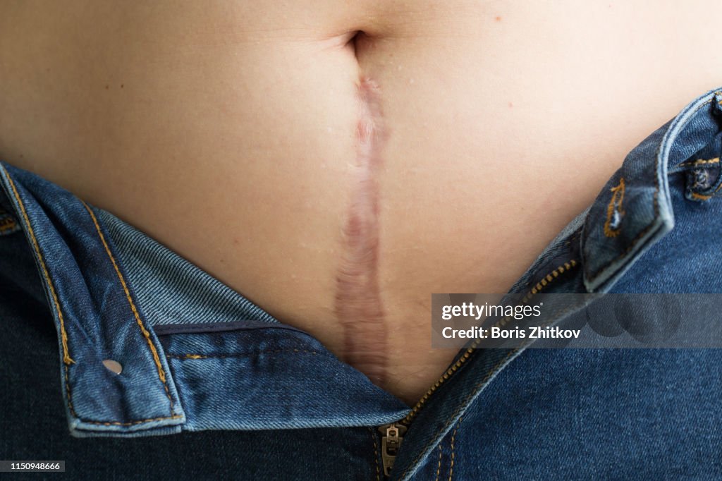 Scar on woman belly