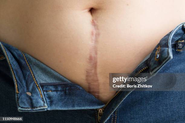 scar on woman belly - mark umbers stock pictures, royalty-free photos & images