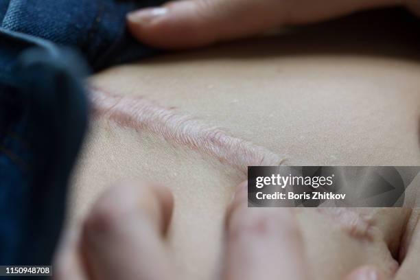 macro shot of scar on belly - keloid stock-fotos und bilder