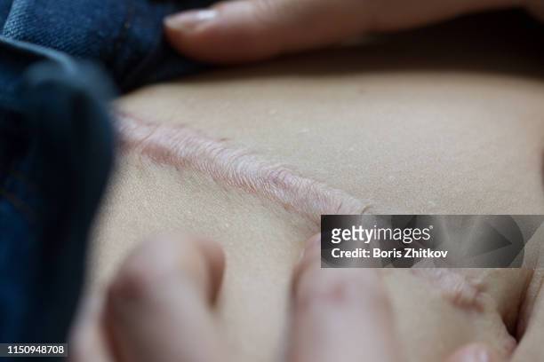macro shot of scar on belly - keloid stockfoto's en -beelden