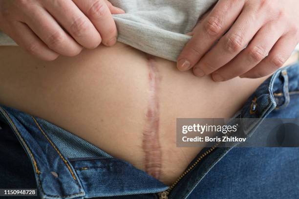 scar on woman belly - keloid stockfoto's en -beelden