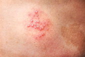 Woman leg skin background with rash from herpes zoster or shingles disease