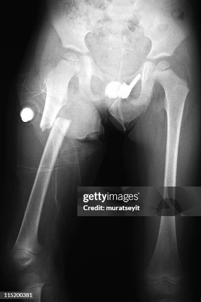 broken leg xxxl - x ray pelvis stock pictures, royalty-free photos & images