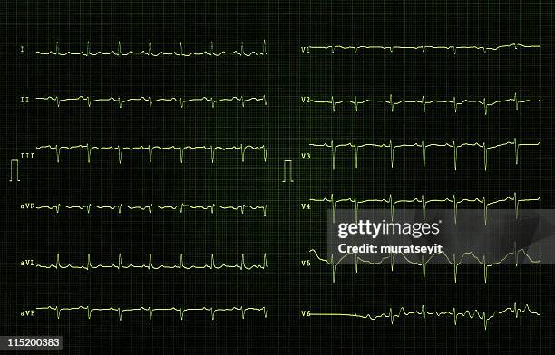 心電図 xxl - 心臓刺激伝導系 ストックフォトと画像
