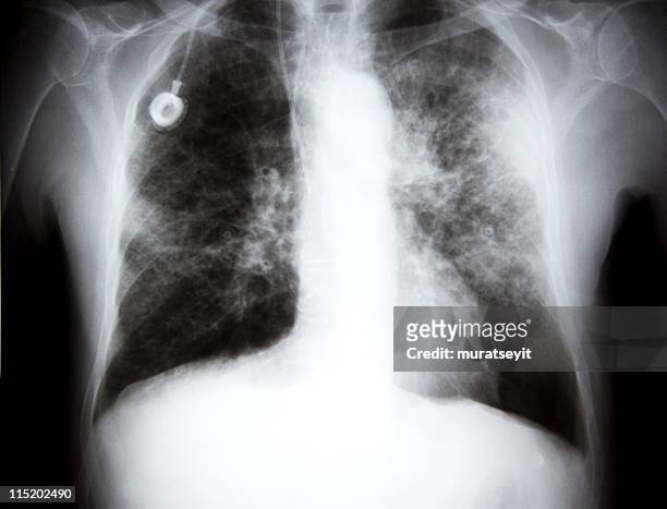 x-ray of a lunge cancer xxl - lung cancer stockfoto's en -beelden