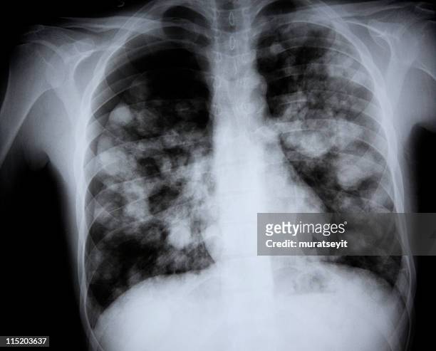 x-ray of a lunge suspected  h7n9 bird flu - lungs stock pictures, royalty-free photos & images