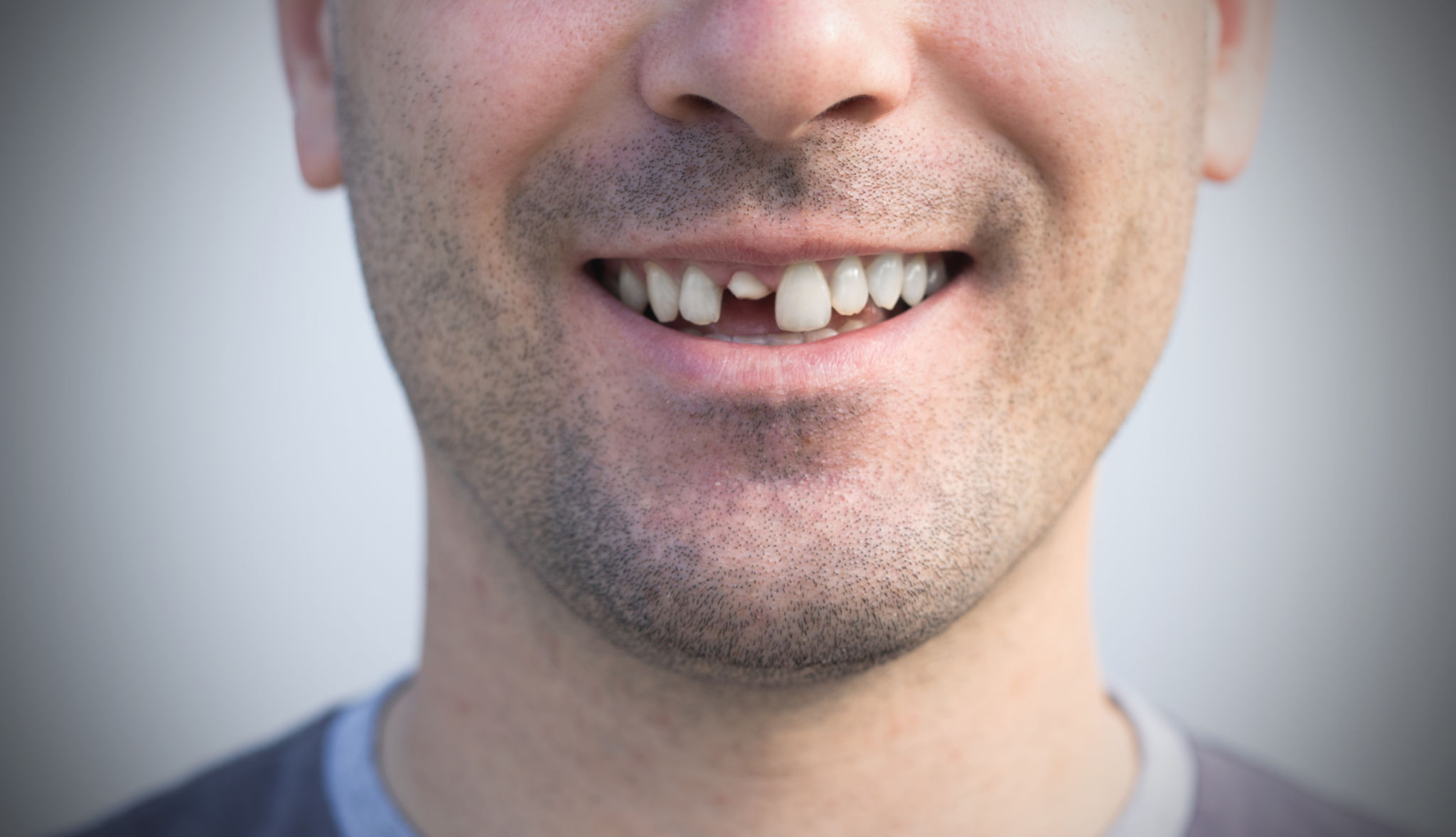 patient before teeth