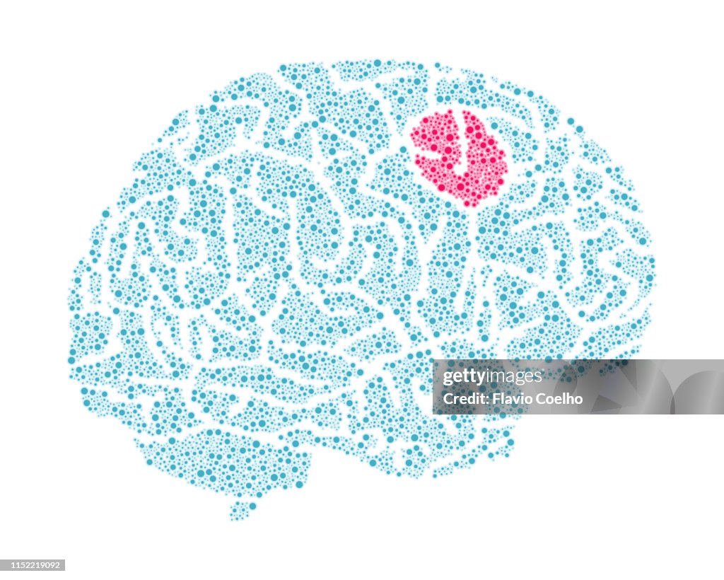 Brain tumor illustration