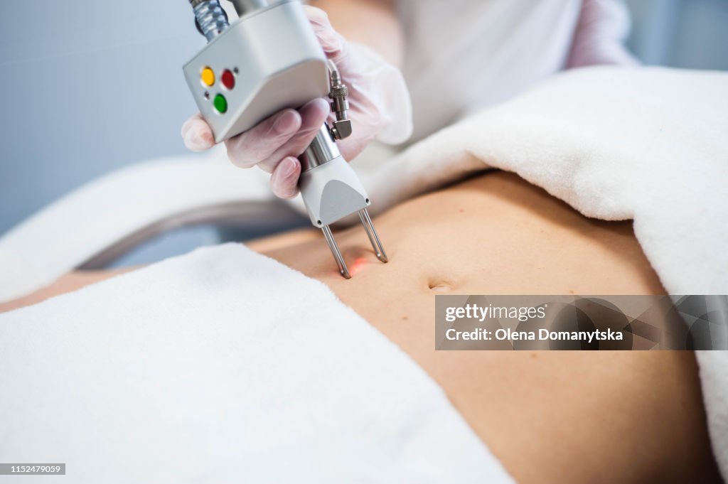 The doctor makes a laser correction of stretch marks on the stomach